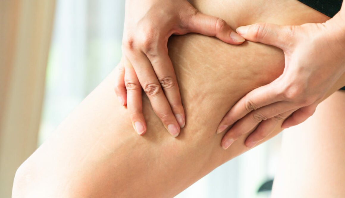 Female hand holds fat cellulite and stretch mark on leg at home,