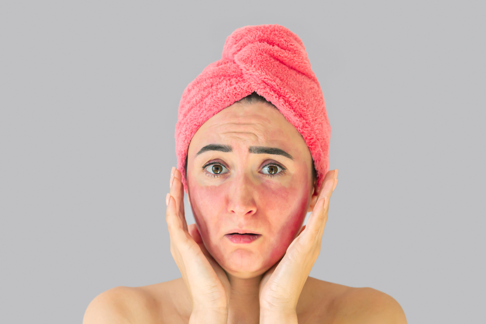 Woman face with skin irritation, problems, acne, rash or sunburn